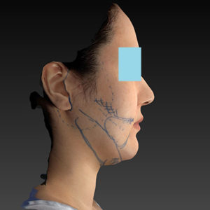 新宿ラクル美容外科クリニック　山本厚志　「ナチュラルフェイスネックリフト」「ライポライフ脂肪吸引（ジョールファット+あご下）」　デザイン　１月２日