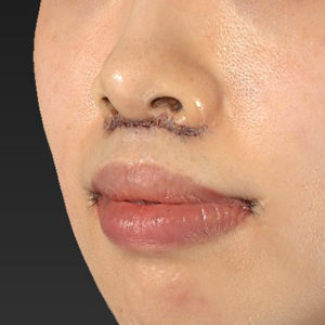新宿ラクル美容外科クリニック　山本厚志　「人中短縮術（リップリフト）＋口角挙上（スマイルリップ）」　手術直後　１２月２７日