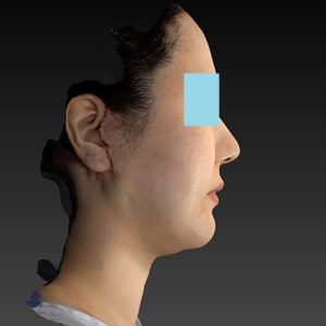 新宿ラクル美容外科クリニック　山本厚志　「ナチュラルフェイスネックリフト」「ライポライフ脂肪吸引（ジョールファット+あご下）」　手術直後　１月２日