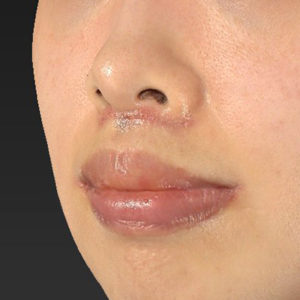 新宿ラクル美容外科クリニック　山本厚志　「人中短縮術（リップリフト）＋口角挙上（スマイルリップ）」　手術後１週間目　１２月２７日