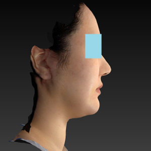 新宿ラクル美容外科クリニック　山本厚志　「ナチュラルフェイスネックリフト」「ライポライフ脂肪吸引（ジョールファット+あご下）」　手術後１週間目　１月２日