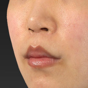 新宿ラクル美容外科クリニック　山本厚志　「人中短縮術（リップリフト）＋口角挙上（スマイルリップ）」　手術後１２ヶ月目　５月１７日