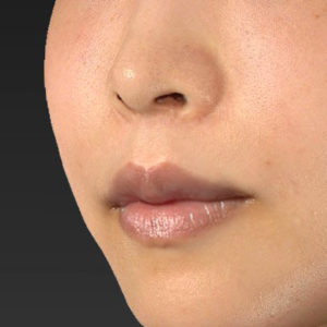 新宿ラクル美容外科クリニック　山本厚志　「人中短縮術（リップリフト）＋口角挙上（スマイルリップ）」　手術後１２ヶ月目　６月３日