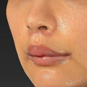 新宿ラクル美容外科クリニック　山本厚志　「人中短縮術（リップリフト）＋口角挙上（スマイルリップ）」　手術後１ヶ月目　１２月２９日