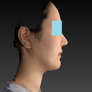 新宿ラクル美容外科クリニック　山本厚志　「ナチュラルフェイスネックリフト」「ライポライフ脂肪吸引（ジョールファット+あご下）」　手術後１ヶ月目　１月２日