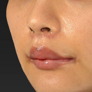新宿ラクル美容外科クリニック　山本厚志　「人中短縮術（リップリフト）＋口角挙上（スマイルリップ）」　手術後２ヶ月目　１２月２９日