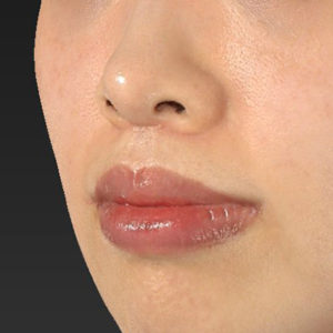 新宿ラクル美容外科クリニック　山本厚志　「人中短縮術（リップリフト）＋口角挙上（スマイルリップ）」　手術後２ヶ月目　１月２７日