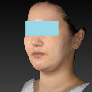 新宿ラクル美容外科クリニック　山本厚志　「ナチュラルフェイスネックリフト」「ライポライフ脂肪吸引（ジョールファット+あご下）」　手術前　１月２日