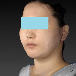 新宿ラクル美容外科クリニック　山本厚志　「ナチュラルフェイスネックリフト」「ライポライフ脂肪吸引（ジョールファット+あご下）」　手術直後　１月２日