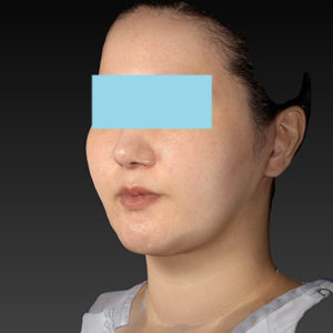 新宿ラクル美容外科クリニック　山本厚志　「ナチュラルフェイスネックリフト」「ライポライフ脂肪吸引（ジョールファット+あご下）」　手術後１ヶ月目　１月２日