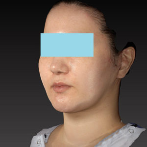 新宿ラクル美容外科クリニック　山本厚志　「ナチュラルフェイスネックリフト」「ライポライフ脂肪吸引（ジョールファット+あご下）」　手術後２ヶ月目　１月２日