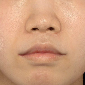 新宿ラクル美容外科クリニック　山本厚志　「口角挙上（スマイルリップ）+ 人中短縮術（リップリフト）」　手術後１２ヶ月目　２月２６日