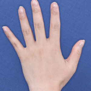 新宿ラクル美容外科クリニック　山本厚志　「手の若返り（プレミアムPRP×FGF皮膚再生療法）」　治療後１２ヶ月目　７月１１日