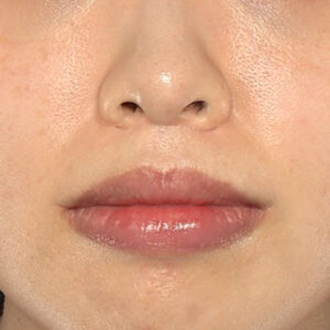 新宿ラクル美容外科クリニック　山本厚志　「人中短縮術（リップリフト）＋口角挙上（スマイルリップ）」　手術後１２ヶ月目　１１月２２日