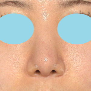 「鼻中隔延長＋耳介軟骨移植＋鼻尖形成＋猫手術＋貴族手術＋鼻骨骨切り幅寄せ」　新宿ラクル美容外科クリニック　２０代女性　手術後２ヶ月目　２月２２日