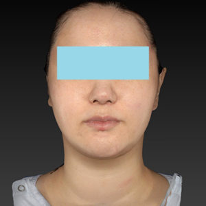 新宿ラクル美容外科クリニック　山本厚志　「ナチュラルフェイスネックリフト」「ライポライフ脂肪吸引（ジョールファット+あご下）」　手術後３ヶ月目　１月２９日