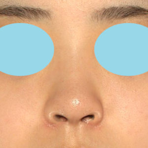 新宿ラクル美容外科クリニック　山本厚志　「小鼻縮小+α法 ＋ 鼻孔縁下降術」　手術後３ヶ月目　１月２５日