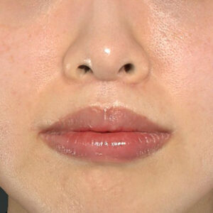 新宿ラクル美容外科クリニック　山本厚志　「人中短縮術（リップリフト）＋口角挙上（スマイルリップ）」　手術後３ヶ月目　１１月２２日