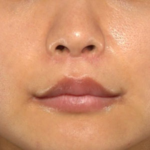 新宿ラクル美容外科クリニック　山本厚志　「人中短縮術（リップリフト）＋口角挙上（スマイルリップ）」　手術後６ヶ月目　２月１２日