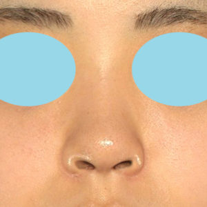 新宿ラクル美容外科クリニック　山本厚志　「小鼻縮小+α法 ＋ 鼻孔縁下降術」　手術後６ヶ月目　３月１６日