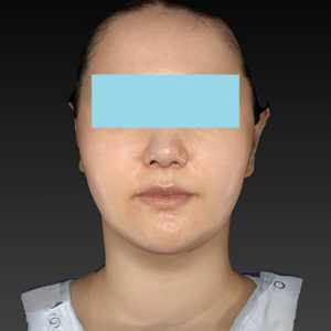 新宿ラクル美容外科クリニック　山本厚志　「ナチュラルフェイスネックリフト」「ライポライフ脂肪吸引（ジョールファット+あご下）」　手術後６ヶ月目　５月５日