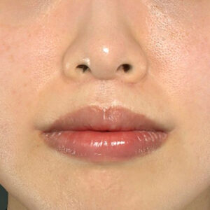 新宿ラクル美容外科クリニック　山本厚志　「人中短縮術（リップリフト）＋口角挙上（スマイルリップ）」　手術後６ヶ月目　１１月２２日