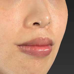 新宿ラクル美容外科クリニック　山本厚志　「人中短縮術（リップリフト）＋口角挙上（スマイルリップ）」　手術後１２ヶ月目　１１月２２日