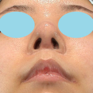 「鼻中隔延長＋耳介軟骨移植＋鼻尖形成＋猫手術＋貴族手術＋鼻骨骨切り幅寄せ」　新宿ラクル美容外科クリニック　２０代女性　手術後２ヶ月目　２月２２日