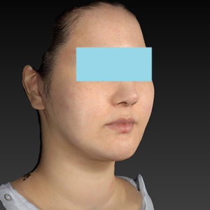 新宿ラクル美容外科クリニック　山本厚志　「ナチュラルフェイスネックリフト」「ライポライフ脂肪吸引（ジョールファット+あご下）」　手術後３ヶ月目　１月２９日