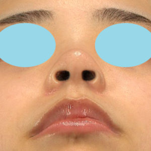 新宿ラクル美容外科クリニック　山本厚志　「小鼻縮小+α法 ＋ 鼻孔縁下降術」　手術後３ヶ月目　１月２５日