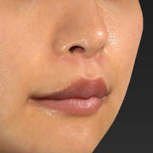 新宿ラクル美容外科クリニック　山本厚志　「人中短縮術（リップリフト）＋口角挙上（スマイルリップ）」　手術後６ヶ月目　２月１２日