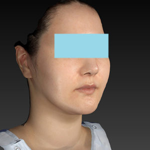 新宿ラクル美容外科クリニック　山本厚志　「ナチュラルフェイスネックリフト」「ライポライフ脂肪吸引（ジョールファット+あご下）」　手術後６ヶ月目　５月５日