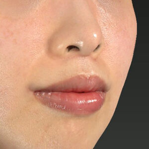 新宿ラクル美容外科クリニック　山本厚志　「人中短縮術（リップリフト）＋口角挙上（スマイルリップ）」　手術後６ヶ月目　１１月２２日