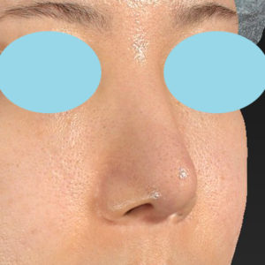 「鼻中隔延長＋耳介軟骨移植＋鼻尖形成＋猫手術＋貴族手術＋鼻骨骨切り幅寄せ」　新宿ラクル美容外科クリニック　２０代女性　手術後２ヶ月目　２月２２日