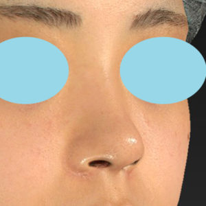 新宿ラクル美容外科クリニック　山本厚志　「小鼻縮小+α法 ＋ 鼻孔縁下降術」　手術後６ヶ月目　３月１６日