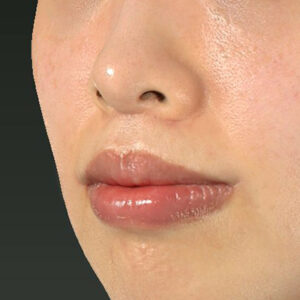 新宿ラクル美容外科クリニック　山本厚志　「人中短縮術（リップリフト）＋口角挙上（スマイルリップ）」　手術後６ヶ月目　１１月２２日