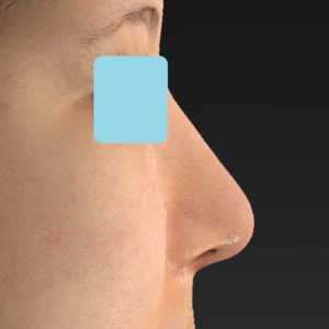 「鼻中隔延長＋耳介軟骨移植＋鼻尖形成＋猫手術＋貴族手術＋鼻骨骨切り幅寄せ」　新宿ラクル美容外科クリニック　２０代女性　手術後２ヶ月目　２月２２日