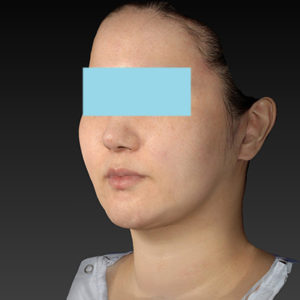 新宿ラクル美容外科クリニック　山本厚志　「ナチュラルフェイスネックリフト」「ライポライフ脂肪吸引（ジョールファット+あご下）」　手術後３ヶ月目　１月２９日