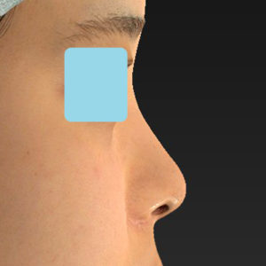 新宿ラクル美容外科クリニック　山本厚志　「小鼻縮小+α法 ＋ 鼻孔縁下降術」　手術後６ヶ月目　３月１６日