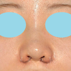 新宿ラクル美容外科クリニック　山本厚志　「貴族手術（鼻翼基部プロテーゼ）＋ 小鼻縮小+α法＋鼻プロテーゼ隆鼻術」　手術直後　２月２７日