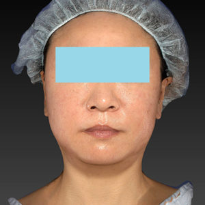 新宿ラクル美容外科クリニック　山本厚志　「アルテミスリフト」　手術直後　２月２３日