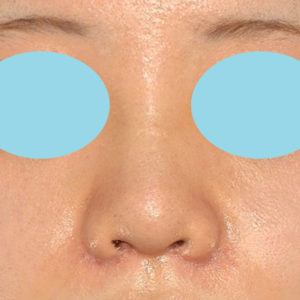 新宿ラクル美容外科クリニック　山本厚志　「貴族手術（鼻翼基部プロテーゼ）＋ 小鼻縮小+α法＋鼻プロテーゼ隆鼻術」　手術後１週間目　２月２７日