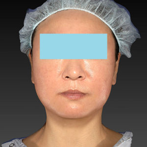 新宿ラクル美容外科クリニック　山本厚志　「アルテミスリフト」　手術後１週間目　２月２３日