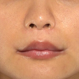 新宿ラクル美容外科クリニック　山本厚志　「人中短縮術（リップリフト）＋口角挙上（スマイルリップ）」　手術後１２ヶ月目　９月４日