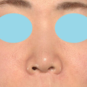 新宿ラクル美容外科クリニック　山本厚志　「小鼻縮小+α法」　手術後１２ヶ月目　１月５日