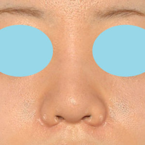 新宿ラクル美容外科クリニック　山本厚志　「貴族手術（鼻翼基部プロテーゼ）＋ 小鼻縮小+α法＋鼻プロテーゼ隆鼻術」　手術後１ヶ月目　２月２７日