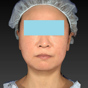 新宿ラクル美容外科クリニック　山本厚志　「アルテミスリフト」　手術後１ヶ月目　２月２３日