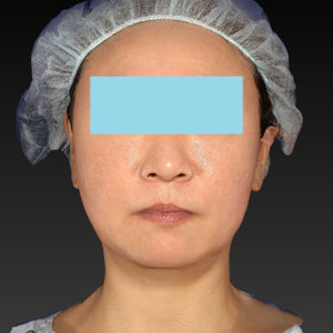 新宿ラクル美容外科クリニック　山本厚志　「アルテミスリフト」　手術後２ヶ月目　２月２３日