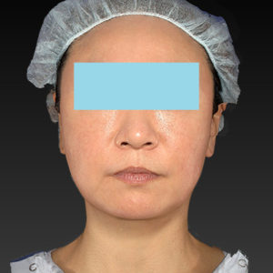 新宿ラクル美容外科クリニック　山本厚志　「アルテミスリフト」　手術後３ヶ月目　3月２３日