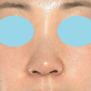 新宿ラクル美容外科クリニック　山本厚志　「小鼻縮小+α法」　手術後６ヶ月目　５月１８日